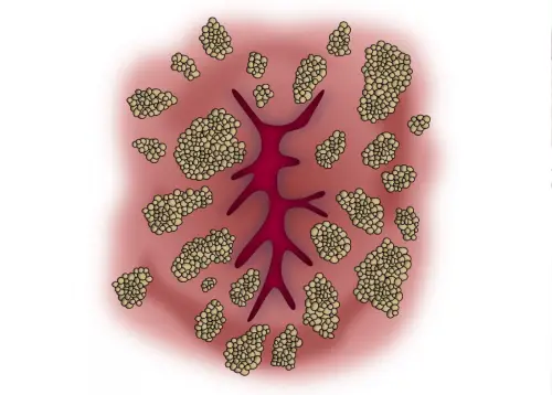 Understanding Anal Warts